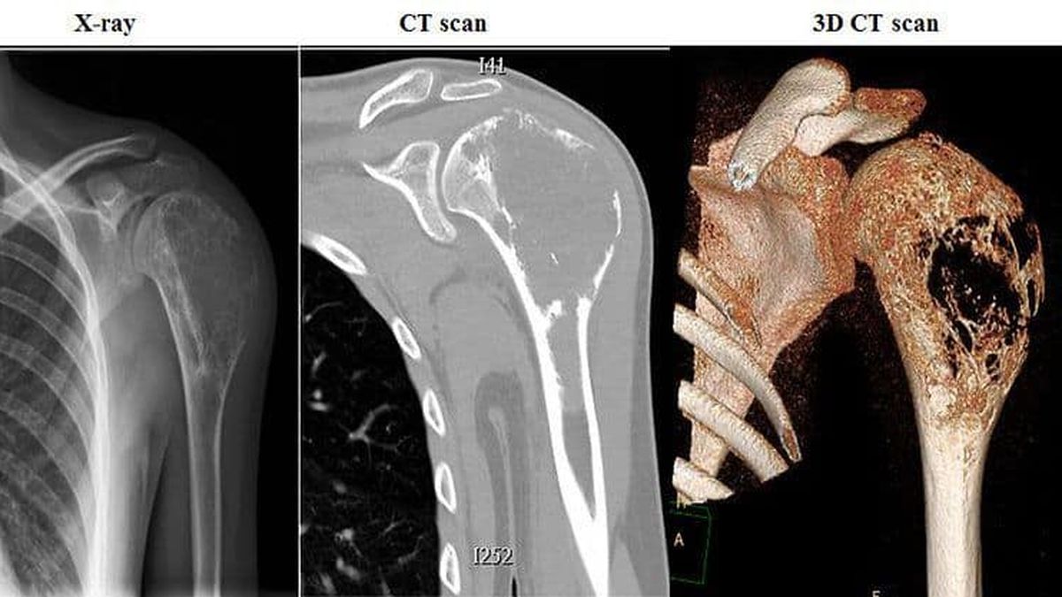 Tiene 13 años padece cáncer óseo y necesita 350 mil dólares para tratarse