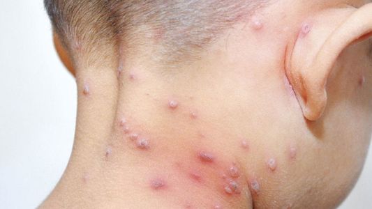 Bélgica decretó cuarentena obligatoria por la viruela del mono: cómo avanza la enfermedad en el mundo