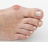 Juanetes en los pies: qué ejercicios recomienda un podólogo para evitar la operación y aliviar el dolor