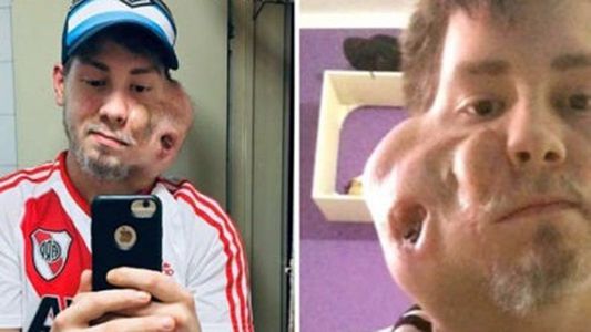 ¿Qué es un sarcoma embrionario maxilar, el extraño tumor que tenía Sebastián Amurín?