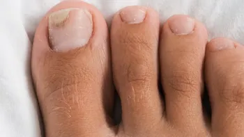 Hongos en las uñas de los pies: cómo prevenir y cuáles son los tratamientos naturales más eficaces