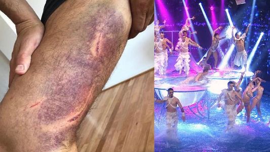Así le quedó la pierna al participante del Bailando tras hacer el Aquadance