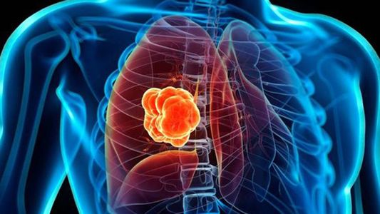 Aprobaron una nueva droga para un subtipo de cáncer de pulmón en la Argentina: ¿qué podría pasar con el tratamiento?