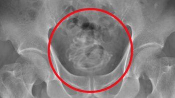 Una tomografía mostró la presencia del objeto en la vejiga del anciano (Foto: Daily Mail).