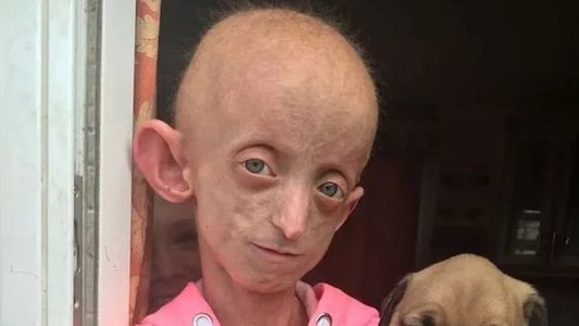 El caso de la adolescente que murió con el cuerpo de una mujer de 144 años