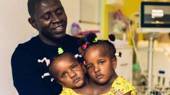 El drama de un padre: que mueran sus dos hijas siamesas o separarlas y que viva sólo una