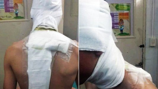 Aberrante episodio en el fútbol de La Pampa: le tiraron agua hirviendo a un futbolista