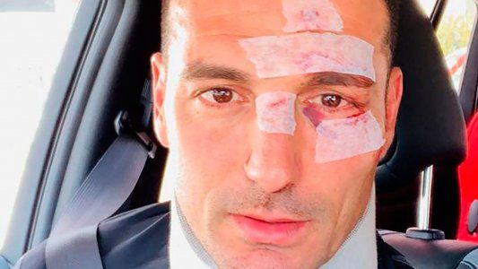 Lionel Scaloni fue atropellado por un auto en España y debió ser internado