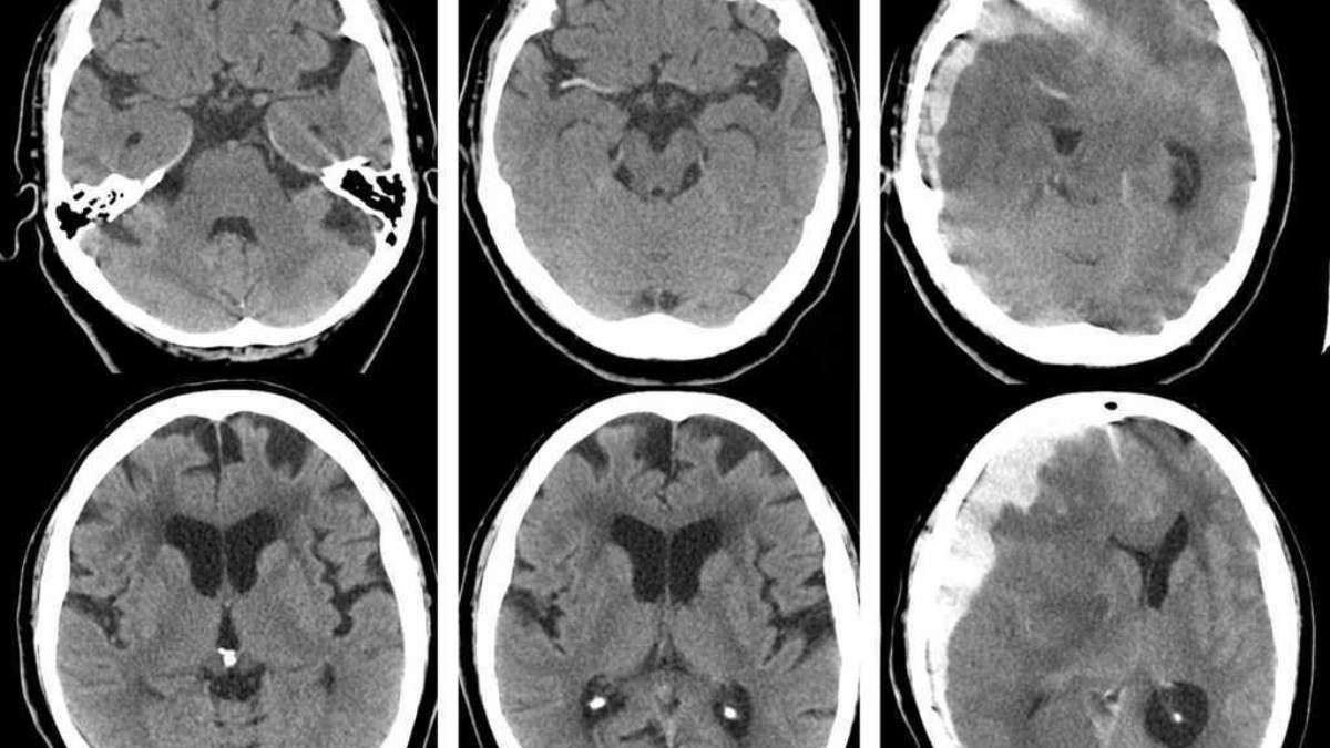 hematoma subdural que une las venas