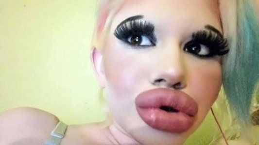 Una joven se sometió a 15 cirugías para aumentar el tamaño de sus labios