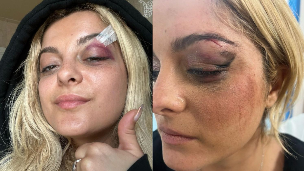 As&iacute; qued&oacute; el rostro de Bebe Rexha tras la agresi&oacute;n (Foto: Instagram @beberexha).