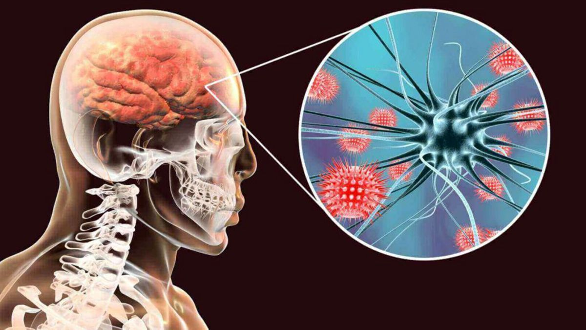 Meningitis en Argentina: se duplicaron los casos en 2022. (Foto: Science Photos)