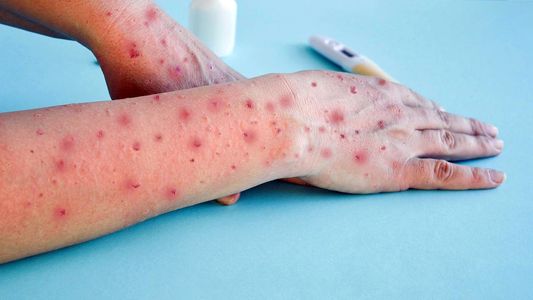 Viruela del mono: ya son 32 los casos en la Argentina y crecen los contagios en la región