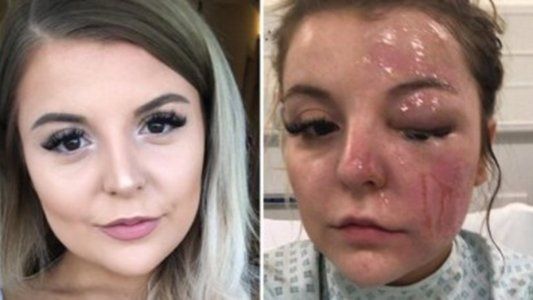 Hacía un huevo duro en el microondas, le explotó y así le quedó la cara