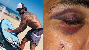 El accidente de Luciano Castro practicando surf: así quedó su rostro