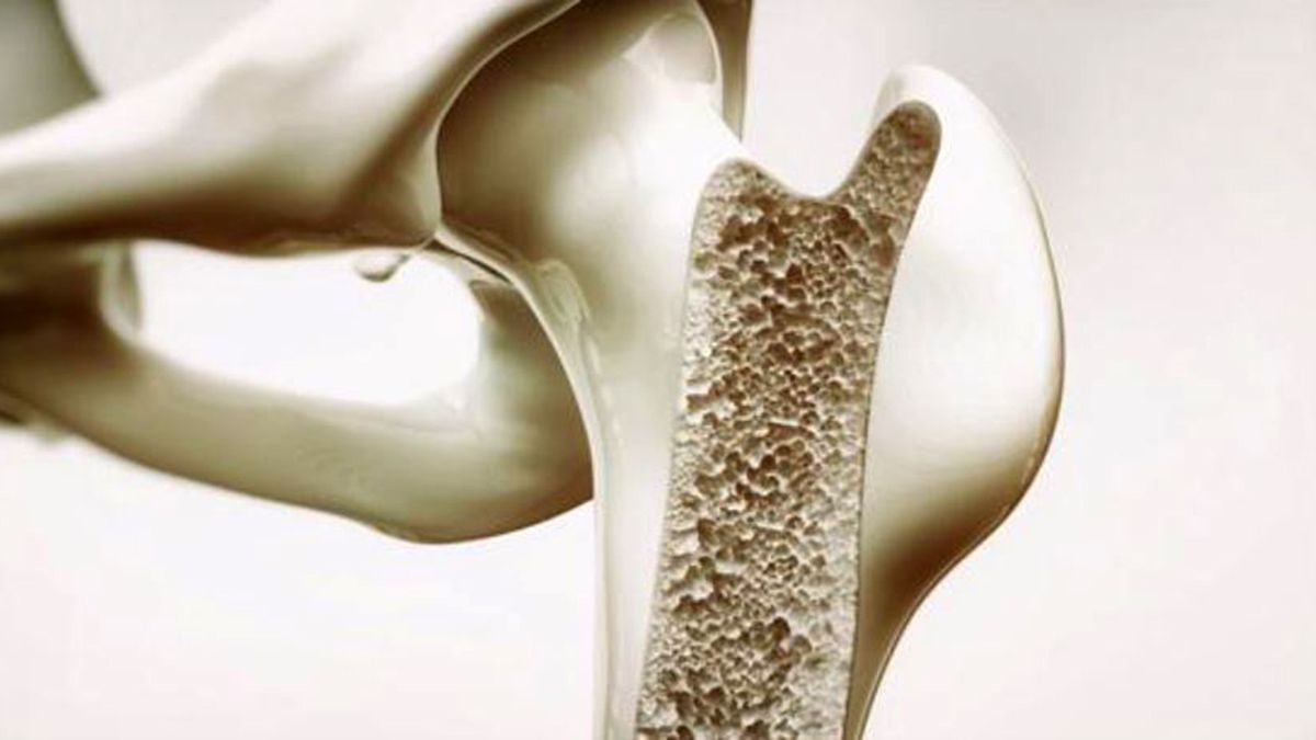 Osteoporosis cómo prevenir la enfermedad que causa 90 fracturas de