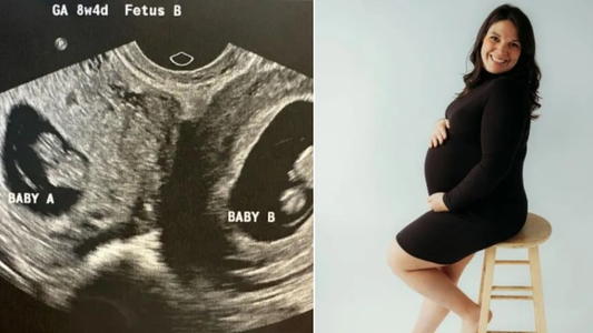 1 en 50 millones: el caso de la mujer que está embarazada en ambos úteros