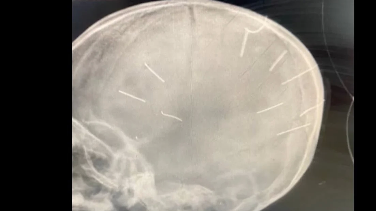 La imagen muestra los clavos dentro de la cabeza de la pequeña.