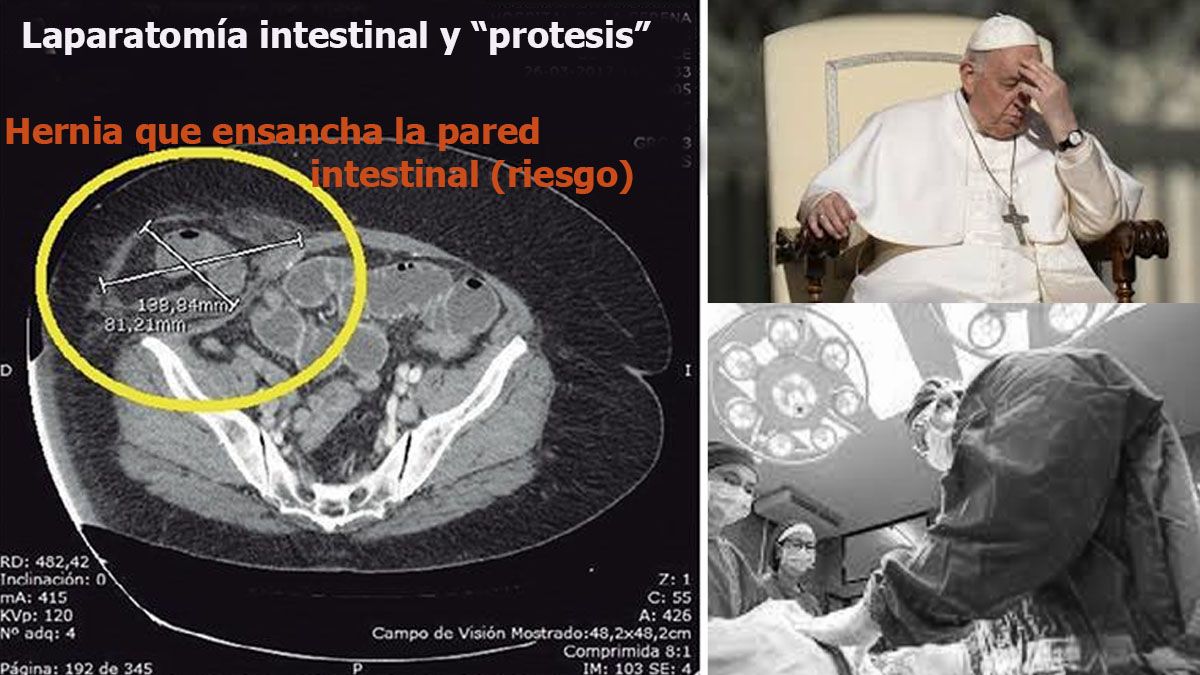 la operación de laparotomía y prótesis a la que se sometió al papa Francisco. (Foto: A24.com)