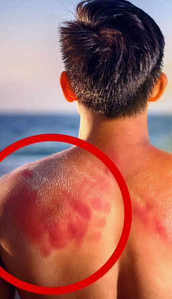Trucos efectivos para aliviar las quemaduras del sol y cuidar tu piel