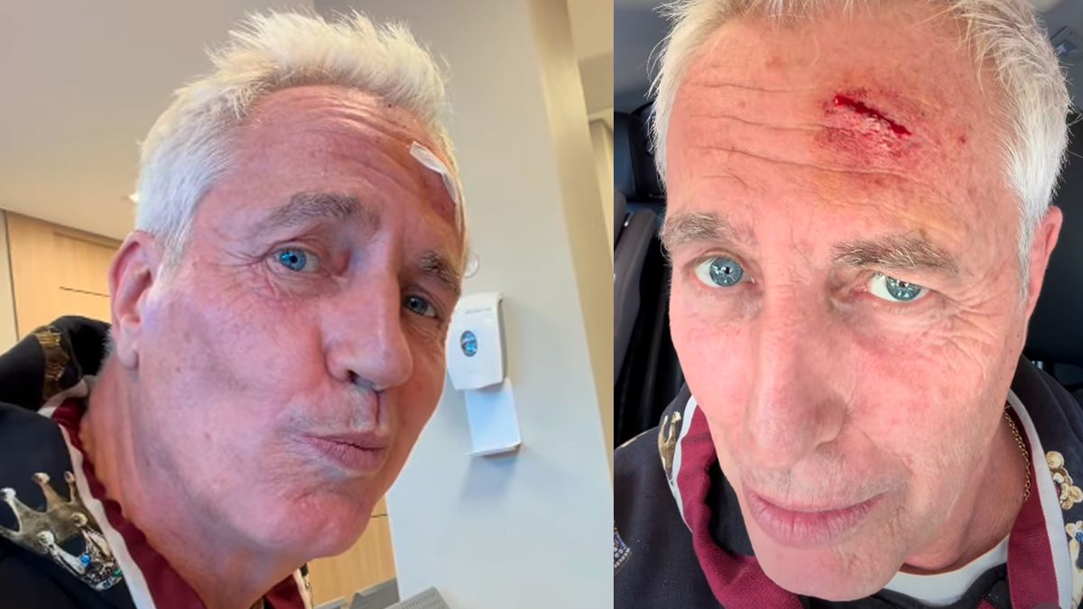 Preocupación total: Marley relató el tremendo accidente que sufrió en la cabeza