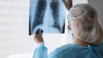 Alerta por la suba de casos de tuberculosis en Argentina: cómo se contagia y cuáles son los síntomas