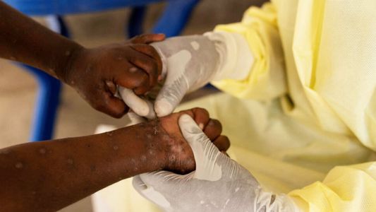 La viruela del mono desató una emergencia sanitaria mundial: cómo se contagia y cuál es el primer síntoma