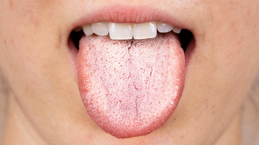 Qué significa tener la lengua blanca y cómo prevenirlo