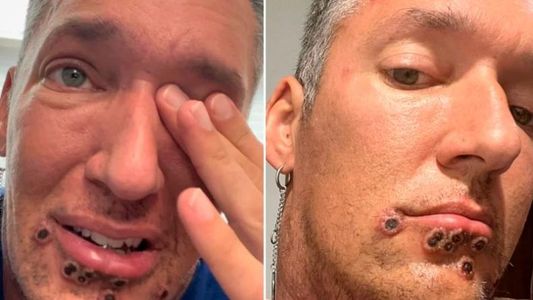 Un hombre se contagió de viruela del mono y asegura que el dolor es insoportable