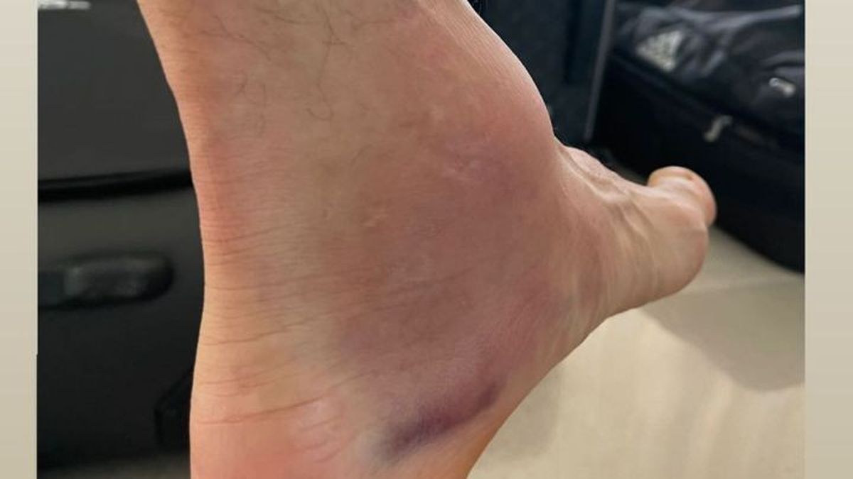 El tobillo de Ángel Di María luego de la final de la Copa América.&nbsp;
