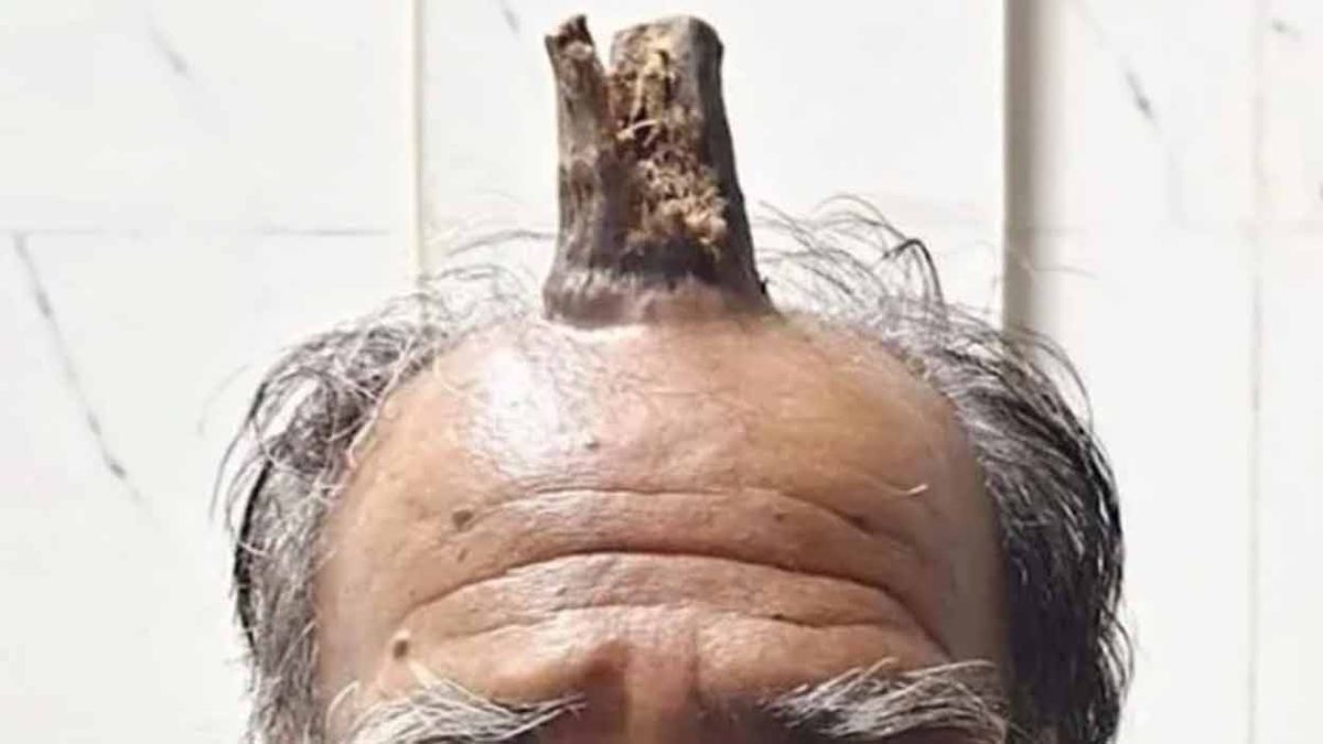 Se golpeó la cabeza y le creció un tronco de árbol en la herida&nbsp;