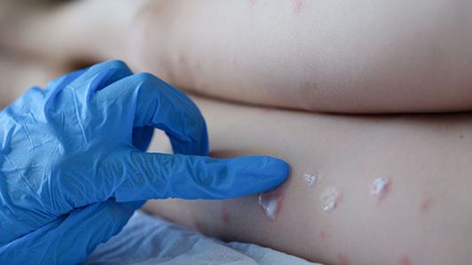 Venezuela registró su primer caso de viruela del mono y sigue la expansión en América: los síntomas y prevención