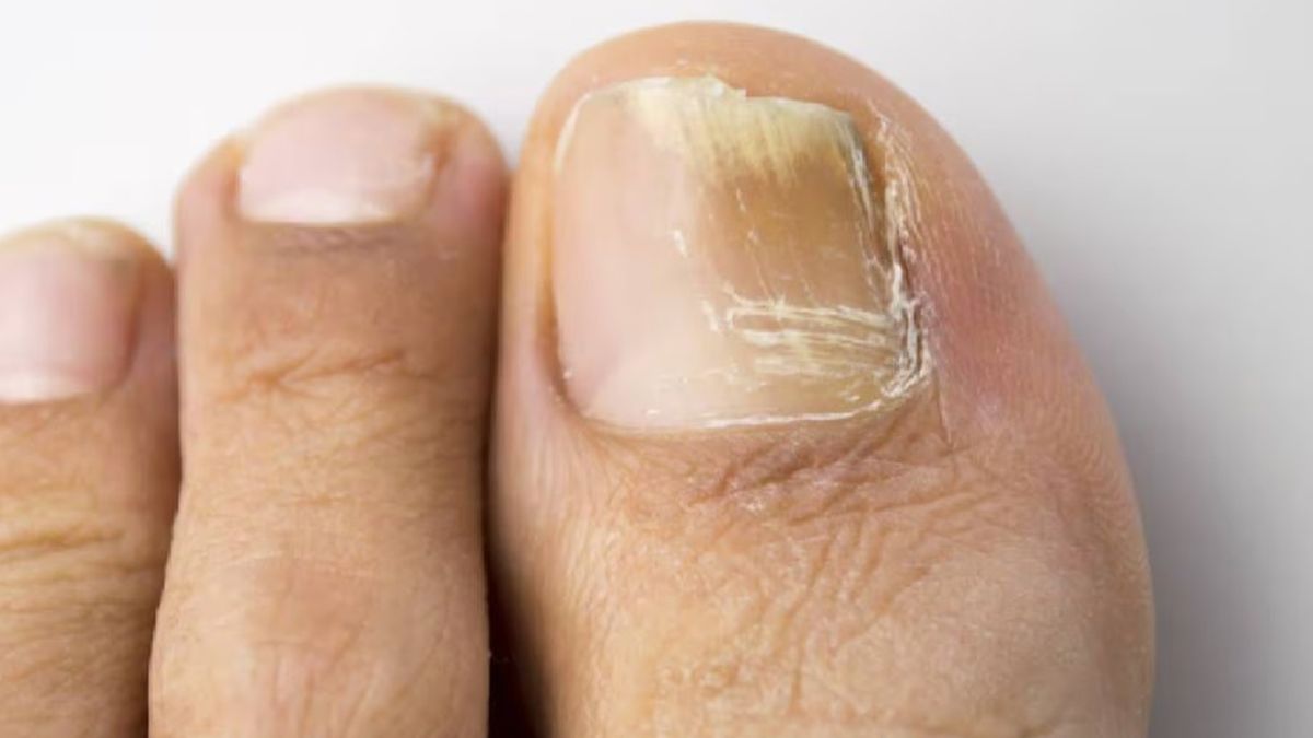 Los hongos en las uñas