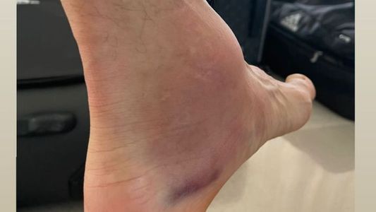 Así quedó el tobillo de la figura de la Selección en la final de la Copa América