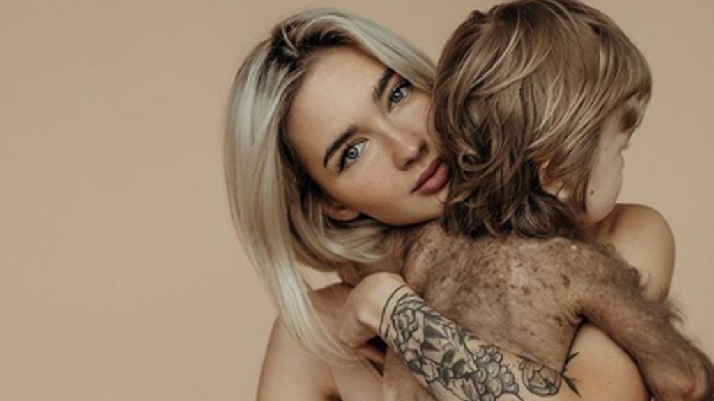 Una influencer decidió visibilizar la extraña enfermedad de la piel que sufre su hijo y conmocionó las redes