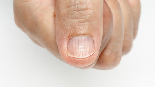 El motivo por el que podés tener las uñas rayadas