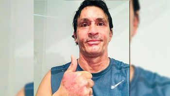 Sebastián Estevanez mostró cómo se recupera tras el accidente doméstico que le provocó quemaduras