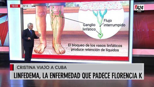 Florencia Kirchner padece una obstrucción linfática llamada linfedema