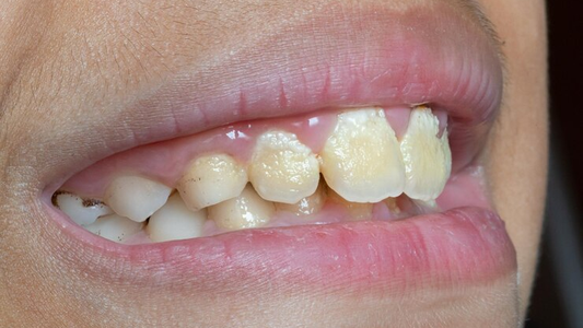 DILE adiós al sarro de los DIENTES con este trucazo casero