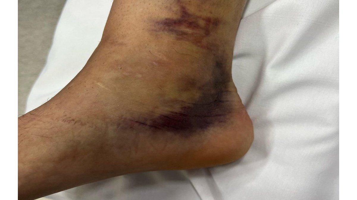 La impactante foto del tobillo de Exequiel Zeballos: así quedó tras la fractura