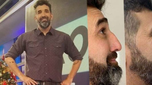 Diego Moranzoni se hizo una intervención en la nariz en vivo: soy otro