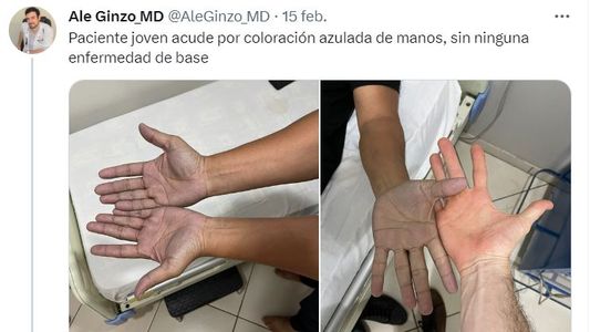 Manos azules: el dilema médico al estilo Doctor House que se resolvió de una manera insólita