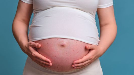 Posible caso de sarampión en la Ciudad: cuándo aplicarse la vacuna