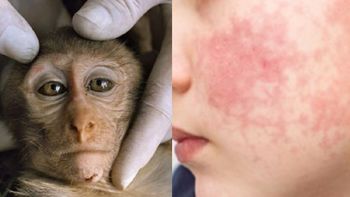 El Ministerio de Salud confirmó un caso sospechoso de viruela de mono en la Argentina