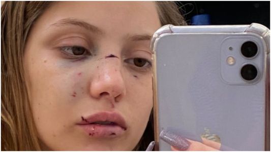 La confundieron con otra chica y una patota la desfiguró a golpes en un boliche de Morón