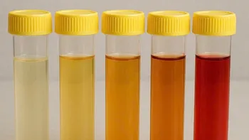 Orina: qué significa su color y cuándo puede ser una señal de alerta