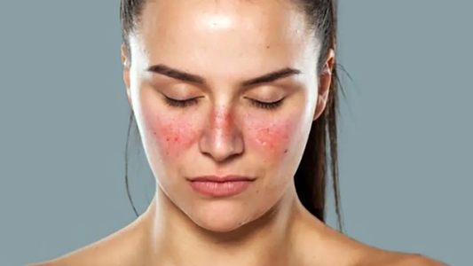 El lupus en el Día Mundial de la Concientización: una enfermedad autoinmunitaria que afecta a millones de personas