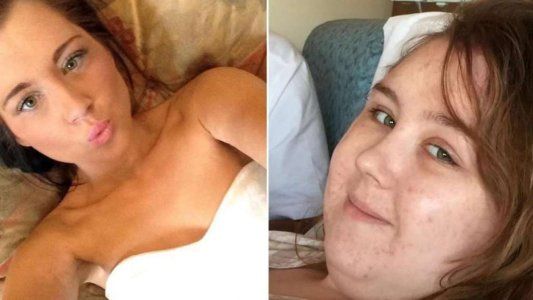 En medio de su lucha contra el cáncer, su novio la dejó por Facebook porque engordó