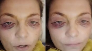 Una ex Gran Hermano apareció con moretones en la cara y preocupó a todos