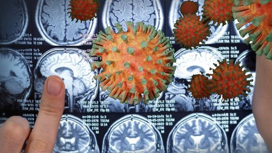 Hallazgo preocupante: detectan una atrofia cerebral en pacientes leves de Covid-19